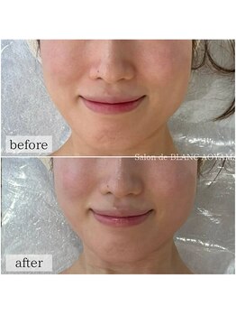 サロン ド ブラン アオヤマ(Salon de BLANC AOYAMA)/クリスティーナ美白ケア