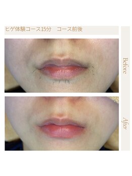 エスト(Est_.)/美容電気脱毛【初回体験前後】