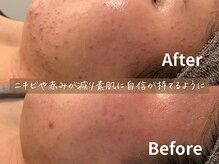バタフライ 平塚店(Butterfly)/できては繰り返すニキビケアに