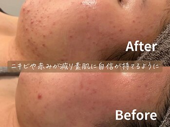 バタフライ 平塚店(Butterfly)/できては繰り返すニキビケアに
