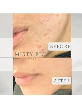 ミスティビオ 平尾店(mistyBIO)/《ニキビケア》
