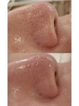 サロン ド ノエル(Salon de Noel)/　毛穴集中ケア