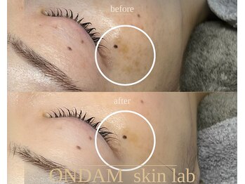 オンダム 表参道(ONDAM)/シミケアもお任せください◎