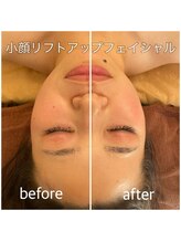 リバース 大阪店(Rebirth)/プラズマ導入フェイシャル