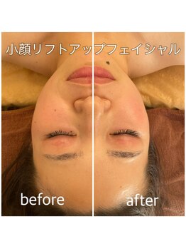 リバース 大阪店(Rebirth)/プラズマ導入フェイシャル