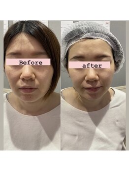 アリウム(Allium)/痩身機械で小顔作り