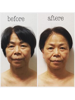 ヒール(heal)/【70代】お顔が老けて見える悩み