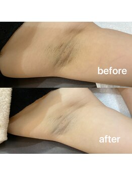 オプレア 千種店(OPREA)/【比較写真】部分ハーブ