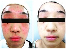 アンレミューラボ(Un Lemieux Labo)/ニキビ、赤み、かぶれ改善