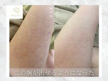 澄葉 新宿(sumiha)の雰囲気(ハーブピーリング/肌質改善/二の腕ケア)