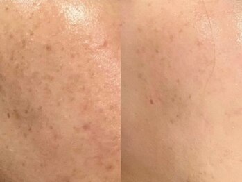 ユウビビューティサロン 東生駒(Yuubi Beauty Salon)/【peel stage】ハーブピーリング