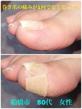 巻き爪じゅん 船橋店/巻き爪のツラさ1回でなくなった