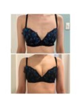 美人バスト 表参道店/【バストアップ/育乳 症例】