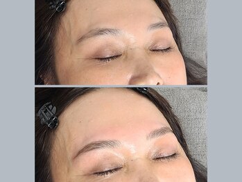 エイプリルプラス(April plus)/ヒゲ脱毛