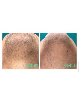 ふわり 別府店(FUWARI)/【メンズ脱毛】　Before・After