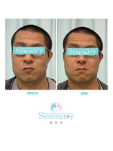 シンメトリー 池袋店/小顔矯正ビフォーアフター