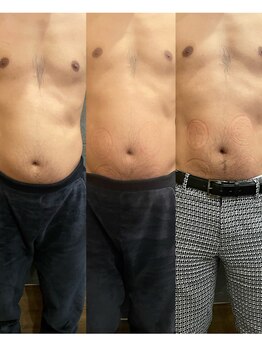 長寿鍼灸院 長寿整骨院/EMS<お腹集中コース>