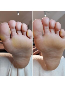 爪切り屋 足楽/定期ケア◆足底のタコ