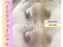 Cスキンケアクリニック 麻布店/毛穴洗浄ハイドラフェイシャル