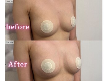 ジュエルリング(Jewel Ring)/症例写真バストアップ