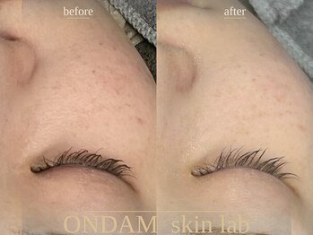 オンダム 表参道(ONDAM)/毛穴引き締めでリフトアップ効果