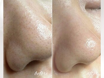 セリジェ 青山(Cerisier)の写真/【毛穴エクストラクション最新技術導入】敏感肌も◎皮脂汚れを根本から除去！お鼻の黒ずみ・頬の毛穴開きに