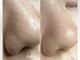 セリジェ 青山(Cerisier)の写真/【毛穴エクストラクション最新技術導入】敏感肌も◎皮脂汚れを根本から除去！お鼻の黒ずみ・頬の毛穴開きに