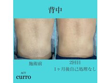 アクト クロ(ACT curro)/【背中下】脱毛施術例