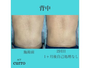 アクト クロ(ACT curro)/【背中下】脱毛施術例