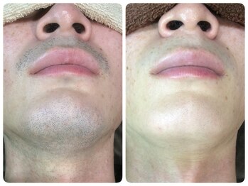 脱毛サロン ベル(Bell)/大人気◎【ヒゲ＆顔脱毛】