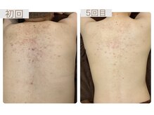 エステティックサロン シノヤ(Shinoya)の雰囲気(背中集中美肌育成ケア*プロユースのサロンケアで肌質を整えます)