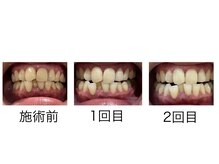 シード(SHE°)/セルフホワイトニング