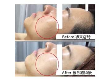 サルヴァトーレ 長崎/シミシワ改善/ニキビケア/毛穴