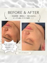 オプス ライフビューティー(OPS×LIFE BEAUTY)/痛みほぼなし！全顔LED脱毛☆