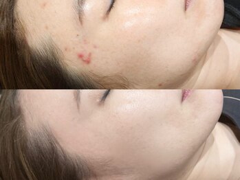 ダリアビューティー(Dahlia Beauty)/プラズマシャワーBefore After