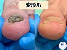 プラスワンフット 本厚木(+1 Foot)/変形・肥厚した爪を正常な爪へ