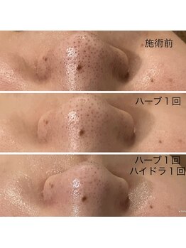 エメ 心斎橋(Aimer)/毛穴の黒ずみケア