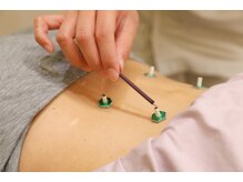 草加鍼灸院 整骨院/お灸もやっています！