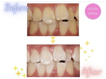 エクシアホワイトニング 明石店/ビフォーアフター