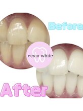 エクシアホワイト 浦安店/ホワイトニングビフォーアフター