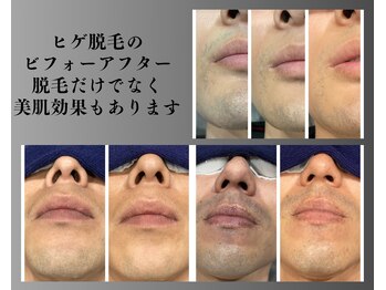 ボゴス(BOGOSS)/脱毛効果だけでなく肌も綺麗に!