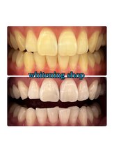 ホワイトニングショップ 大阪玉造店/Before&After美白ホワイトニング