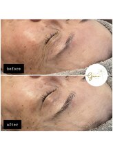 グレイス(Grace)/光フェイシャル