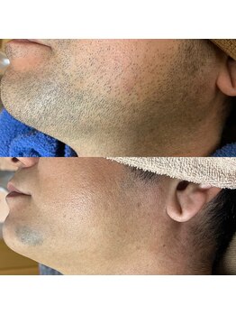 シエル 美里店(ciel)/メンズ脱毛