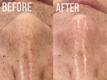 煌(kirameki)/毛穴洗浄/水素ハイドロ