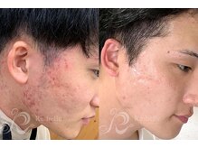 エルビービュティーサロン(LB BEAUTY SALON)/【ニキビ改善】ハーブピーリング