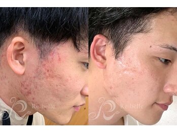 エルビービュティーサロン(LB BEAUTY SALON)/【ニキビ改善】ハーブピーリング