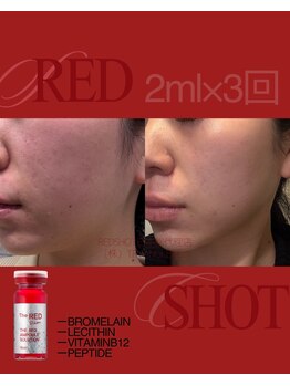 スズ(SUZU)の写真/REDSHOT＊日本上陸1周年！綺麗なお顔のVラインづくりしたい方へ。