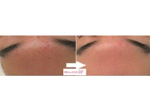 サロンドエステケイワイ(de KY)/フェイシャル☆ニキビ改善