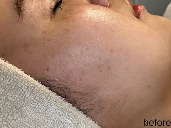 サロン ド エメ(salon de aimer)/【Before】シミもお任せあれ♪